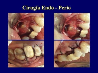 Cirugía Endo - PerioCirugía Endo - Perio
 