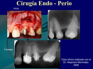 Cirugía Endo - Perio
Inicio
3 meses
Caso clinico realizado con el
Dr. Alejandro Marmolejo.
2006
 
