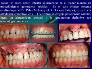 Todos los casos deben intentar solucionarse en el menor numero de
procedimientos quirurgicos posibles. En el caso clinico presente
(realizado por el Dr. Pablo Molano y el Dr. Ricardo Salazar), se realiza la
ortodoncia correctiva, en el 11 se realiza un colgajo posicionado coronal,
luego un alargamiento coronal y la restauracion definitiva con
odontologia cosmetica.
 