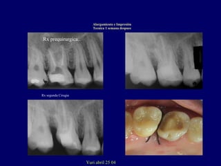 Rx segunda Cirugia
Rx primera cirugia.
Rx prequirurgica..
Yuri abril 25 04
Alargamiento e Impresión
Tecnica 1 semana despues
 