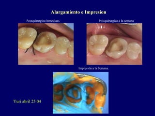 Postquirurgico inmediato.
Impresión a la Semana.
Postquirurgico a la semana
Yuri abril 25 04
Alargamiento e Impresion
 