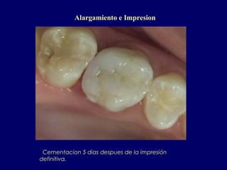 Cementacion 5 dias despues de la impresión
definitiva.
Alargamiento e Impresion
 