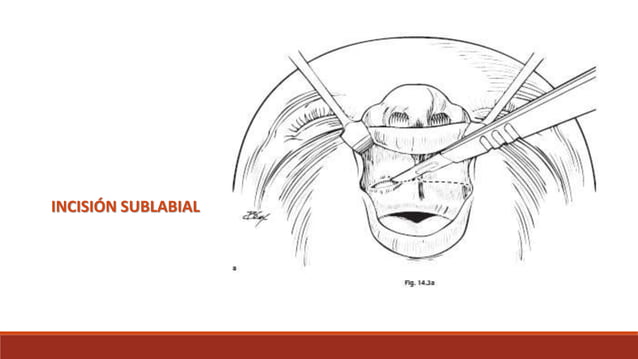 Sublabial Excision Cirugia de atresia coanal y estenosis anterior nasal | PPTX