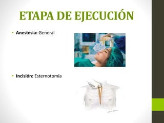 ETAPA DE EJECUCIÓN
• Anestesia: General
• Incisión: Esternotomía
 