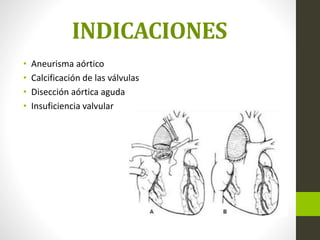 INDICACIONES
• Aneurisma aórtico
• Calcificación de las válvulas
• Disección aórtica aguda
• Insuficiencia valvular
 