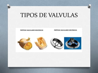 TIPOS DE VALVULAS
 