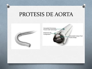PROTESIS DE AORTA
 
