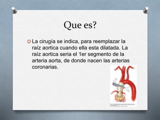Que es?
O La cirugía se indica, para reemplazar la
raíz aortica cuando ella esta dilatada. La
raíz aortica seria el 1er segmento de la
arteria aorta, de donde nacen las arterias
coronarias.
 