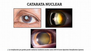 CIRUGIA DE CATARATA : EVALUACION Y MANEJO CLINICO | PDF