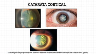 CIRUGIA DE CATARATA : EVALUACION Y MANEJO CLINICO | PDF
