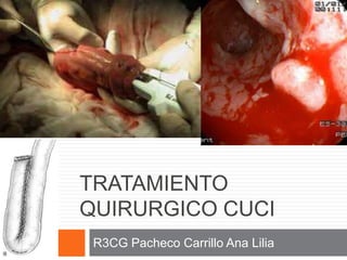R3CG Pacheco Carrillo Ana Lilia
TRATAMIENTO
QUIRURGICO CUCI
 