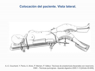 Colocación del paciente. Vista lateral.
A.-C. Couchard, Y. Panis, A. Alves, P. Mariani, P. Valleur. Técnicas de anastomosis ileoanales con reservorio.
EMC - Técnicas quirúrgicas - Aparato digestivo 2005:1-13 [Article 40-669].
 