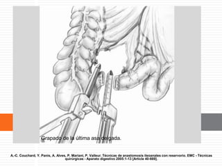 Grapado de la última asa delgada.
A.-C. Couchard, Y. Panis, A. Alves, P. Mariani, P. Valleur. Técnicas de anastomosis ileoanales con reservorio. EMC - Técnicas
quirúrgicas - Aparato digestivo 2005:1-13 [Article 40-669].
 