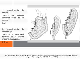 Los dos procedimientos de plastia
mesentérica.1: procedimiento de
Dozois.
Sección del pedículo
ileocecal cerca de su
origen
5cm
2: procedimiento de
Utsunomiya.
Secciona la rama ileal
terminal de la arteria
mesentérica superior.
5-6 cm
A.-C. Couchard, Y. Panis, A. Alves, P. Mariani, P. Valleur. Técnicas de anastomosis ileoanales con reservorio. EMC - Técnicas
quirúrgicas - Aparato digestivo 2005:1-13 [Article 40-669].
 