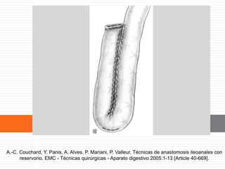 Reservorio en J.
A.-C. Couchard, Y. Panis, A. Alves, P. Mariani, P. Valleur. Técnicas de anastomosis ileoanales con
reservorio. EMC - Técnicas quirúrgicas - Aparato digestivo 2005:1-13 [Article 40-669].
 
