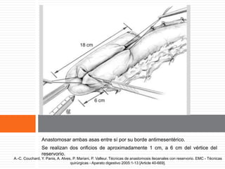 Preparación del reservorio.
Anastomosar ambas asas entre sí por su borde antimesentérico.
Se realizan dos orificios de aproximadamente 1 cm, a 6 cm del vértice del
reservorio.
A.-C. Couchard, Y. Panis, A. Alves, P. Mariani, P. Valleur. Técnicas de anastomosis ileoanales con reservorio. EMC - Técnicas
quirúrgicas - Aparato digestivo 2005:1-13 [Article 40-669].
 