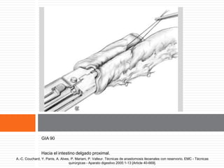Introducción de la GIA.
GIA 90
Hacia el intestino delgado proximal.
A.-C. Couchard, Y. Panis, A. Alves, P. Mariani, P. Valleur. Técnicas de anastomosis ileoanales con reservorio. EMC - Técnicas
quirúrgicas - Aparato digestivo 2005:1-13 [Article 40-669].
 