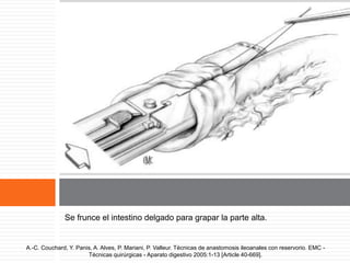 Se frunce el intestino delgado para grapar la parte alta.
A.-C. Couchard, Y. Panis, A. Alves, P. Mariani, P. Valleur. Técnicas de anastomosis ileoanales con reservorio. EMC -
Técnicas quirúrgicas - Aparato digestivo 2005:1-13 [Article 40-669].
 