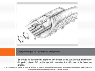 Grapado de la parte alta
Comprobar que no haya meso interpuesto.
Se adosa la extremidad superior de ambas asas con puntos separados
de polipropileno 5/0, evitando así cualquier tracción sobre la línea de
grapas.
A.-C. Couchard, Y. Panis, A. Alves, P. Mariani, P. Valleur. Técnicas de anastomosis ileoanales con reservorio. EMC - Técnicas
quirúrgicas - Aparato digestivo 2005:1-13 [Article 40-669].
 