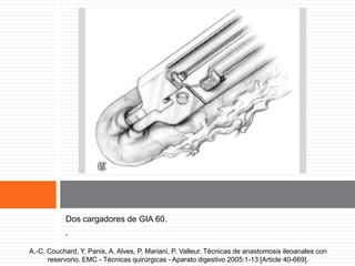 Grapado del segmento inferior.
Dos cargadores de GIA 60.
.
A.-C. Couchard, Y. Panis, A. Alves, P. Mariani, P. Valleur. Técnicas de anastomosis ileoanales con
reservorio. EMC - Técnicas quirúrgicas - Aparato digestivo 2005:1-13 [Article 40-669].
 