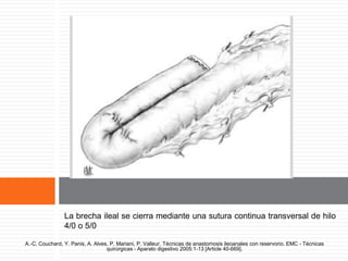 Reservorio en J terminado
La brecha ileal se cierra mediante una sutura continua transversal de hilo
4/0 o 5/0
A.-C. Couchard, Y. Panis, A. Alves, P. Mariani, P. Valleur. Técnicas de anastomosis ileoanales con reservorio. EMC - Técnicas
quirúrgicas - Aparato digestivo 2005:1-13 [Article 40-669].
 