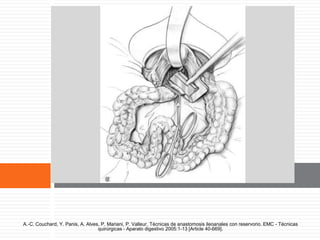 Cierre del recto subperitoneal
A.-C. Couchard, Y. Panis, A. Alves, P. Mariani, P. Valleur. Técnicas de anastomosis ileoanales con reservorio. EMC - Técnicas
quirúrgicas - Aparato digestivo 2005:1-13 [Article 40-669].
 
