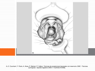 Recto subperitoneal cerrado.
A.-C. Couchard, Y. Panis, A. Alves, P. Mariani, P. Valleur. Técnicas de anastomosis ileoanales con reservorio. EMC - Técnicas
quirúrgicas - Aparato digestivo 2005:1-13 [Article 40-669].
 