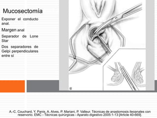 Mucosectomía rectal.
Exponer el conducto
anal.
Margen anal
Separador de Lone
Star
Dos separadores de
Gelpi perpendiculares
entre sí
A.-C. Couchard, Y. Panis, A. Alves, P. Mariani, P. Valleur. Técnicas de anastomosis ileoanales con
reservorio. EMC - Técnicas quirúrgicas - Aparato digestivo 2005:1-13 [Article 40-669].
 