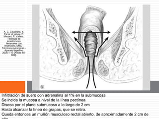 Vista de la mucosectomía (en
sección).
A.-C. Couchard, Y. Panis, A. Alves, P. Mariani, P. Valleur. Técnicas de anastomosis ileoanales
con reservorio. EMC - Técnicas quirúrgicas - Aparato digestivo 2005:1-13 [Article 40-669].
Infiltración de suero con adrenalina al 1% en la submucosa
Se incide la mucosa a nivel de la línea pectínea
Diseca por el plano submucoso a lo largo de 2 cm
Hasta alcanzar la línea de grapas, que se retira.
Queda entonces un muñón musculoso rectal abierto, de aproximadamente 2 cm de
A.-C. Couchard, Y.
Panis, A. Alves, P.
Mariani, P. Valleur.
Técnicas de
anastomosis
ileoanales con
reservorio. EMC -
Técnicas quirúrgicas -
Aparato digestivo
2005:1-13 [Article 40-
669].
 