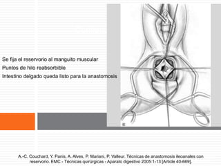 Comienzo de la anastomosis
Se fija el reservorio al manguito muscular
Puntos de hilo reabsorbible
Intestino delgado queda listo para la anastomosis
A.-C. Couchard, Y. Panis, A. Alves, P. Mariani, P. Valleur. Técnicas de anastomosis ileoanales
con reservorio. EMC - Técnicas quirúrgicas - Aparato digestivo 2005:1-13 [Article 40-669].
A.-C. Couchard, Y. Panis, A. Alves, P. Mariani, P. Valleur. Técnicas de anastomosis ileoanales con
reservorio. EMC - Técnicas quirúrgicas - Aparato digestivo 2005:1-13 [Article 40-669].
 
