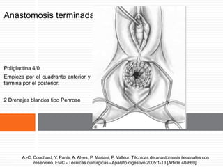 Anastomosis terminada
Poliglactina 4/0
Empieza por el cuadrante anterior y
termina por el posterior.
2 Drenajes blandos tipo Penrose
A.-C. Couchard, Y. Panis, A. Alves, P. Mariani, P. Valleur. Técnicas de anastomosis ileoanales
con reservorio. EMC - Técnicas quirúrgicas - Aparato digestivo 2005:1-13 [Article 40-669].
A.-C. Couchard, Y. Panis, A. Alves, P. Mariani, P. Valleur. Técnicas de anastomosis ileoanales con
reservorio. EMC - Técnicas quirúrgicas - Aparato digestivo 2005:1-13 [Article 40-669].
 