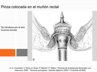 Pinza colocada en el muñón rectal
Se introduce por el ano
la pinza circular.
A.-C. Couchard, Y. Panis, A. Alves, P. Mariani, P. Valleur. Técnicas de anastomosis ileoanales
con reservorio. EMC - Técnicas quirúrgicas - Aparato digestivo 2005:1-13 [Article 40-669].
A.-C. Couchard, Y. Panis, A. Alves, P. Mariani, P. Valleur. Técnicas de anastomosis ileoanales con
reservorio. EMC - Técnicas quirúrgicas - Aparato digestivo 2005:1-13 [Article 40-669].
 