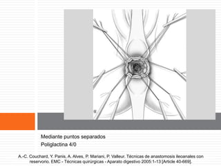 Exposición del conducto anal
evertido
Mediante puntos separados
Poliglactina 4/0
A.-C. Couchard, Y. Panis, A. Alves, P. Mariani, P. Valleur. Técnicas de anastomosis ileoanales
con reservorio. EMC - Técnicas quirúrgicas - Aparato digestivo 2005:1-13 [Article 40-669].
A.-C. Couchard, Y. Panis, A. Alves, P. Mariani, P. Valleur. Técnicas de anastomosis ileoanales con
reservorio. EMC - Técnicas quirúrgicas - Aparato digestivo 2005:1-13 [Article 40-669].
 