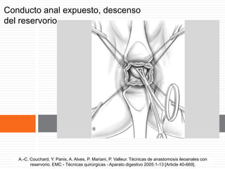 Conducto anal expuesto, descenso
del reservorio.
A.-C. Couchard, Y. Panis, A. Alves, P. Mariani, P. Valleur. Técnicas de anastomosis ileoanales
con reservorio. EMC - Técnicas quirúrgicas - Aparato digestivo 2005:1-13 [Article 40-669].
A.-C. Couchard, Y. Panis, A. Alves, P. Mariani, P. Valleur. Técnicas de anastomosis ileoanales con
reservorio. EMC - Técnicas quirúrgicas - Aparato digestivo 2005:1-13 [Article 40-669].
 