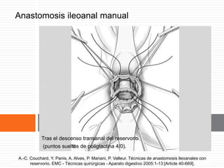 Anastomosis ileoanal manual
Tras el descenso transanal del reservorio
(puntos sueltos de poliglactina 4/0).
A.-C. Couchard, Y. Panis, A. Alves, P. Mariani, P. Valleur. Técnicas de anastomosis ileoanales
con reservorio. EMC - Técnicas quirúrgicas - Aparato digestivo 2005:1-13 [Article 40-669].
A.-C. Couchard, Y. Panis, A. Alves, P. Mariani, P. Valleur. Técnicas de anastomosis ileoanales con
reservorio. EMC - Técnicas quirúrgicas - Aparato digestivo 2005:1-13 [Article 40-669].
 