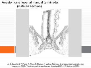 Anastomosis ileoanal manual terminada
(vista en sección).
A.-C. Couchard, Y. Panis, A. Alves, P. Mariani, P. Valleur. Técnicas de anastomosis ileoanales con reservorio. EMC - Técnicas
quirúrgicas - Aparato digestivo 2005:1-13 [Article 40-669].A.-C. Couchard, Y. Panis, A. Alves, P. Mariani, P. Valleur. Técnicas de anastomosis ileoanales con
reservorio. EMC - Técnicas quirúrgicas - Aparato digestivo 2005:1-13 [Article 40-669].
 