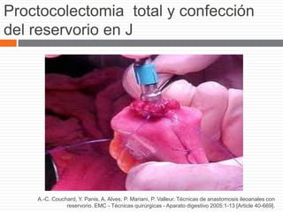 Proctocolectomia total y confección
del reservorio en J
A.-C. Couchard, Y. Panis, A. Alves, P. Mariani, P. Valleur. Técnicas de anastomosis ileoanales con
reservorio. EMC - Técnicas quirúrgicas - Aparato digestivo 2005:1-13 [Article 40-669].
 
