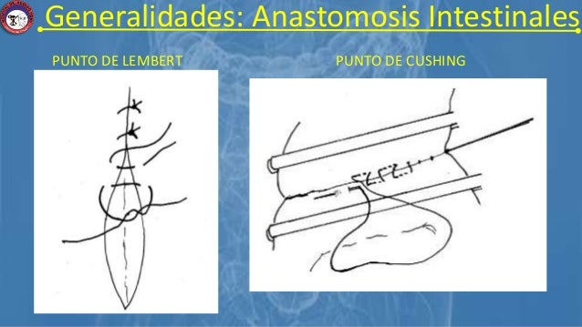 Puntos De Lembert Y Cushing