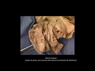 Nervio lingual
(sobre la pinza, por encima del nervio el conducto de Warthon)
 