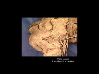 Arteria Lingual
A su salida de la carótida
 