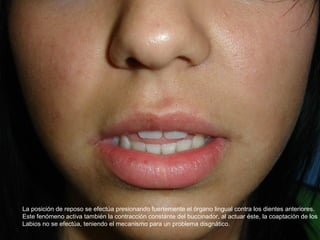 La posición de reposo se efectúa presionando fuertemente el órgano lingual contra los dientes anteriores.
Este fenómeno activa también la contracción constante del buccinador, al actuar éste, la coaptación de los
Labios no se efectúa, teniendo el mecanismo para un problema disgnático.
 