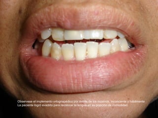 Observese el implemento ortognapédico por detrás de los incisivos, inconciente y hábilmente
La paciente logró evadirlo para recolocar la lengua en su posición de comodidad.
 