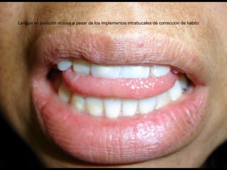 Lengua en posición viciosa a pesar de los implementos intrabucales de corrección de hábito
 