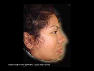 Protrusión bimaxilar por hábito lingual incontrolable
 