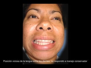 Posición viciosa de la lengua entre los dientes, no respondió a manejo conservador
 