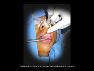 Sedal en la punta de la lengua para su control durante la operación
 