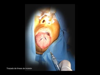 Trazado de líneas de incisión
 