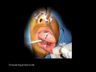 Torniquete lingual hasta el rafé
 
