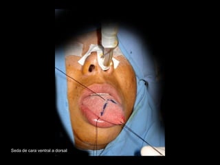 Seda de cara ventral a dorsal
 