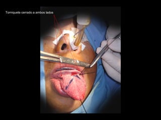 Torniquete cerrado a ambos lados
 